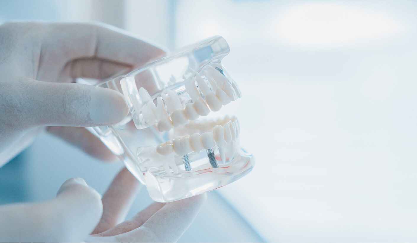 インプラントが埋め込まれた顎の模型を使い、治療について説明している様子