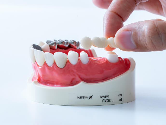連結した被せ物（ブリッジ）を、歯のない部分の両隣の歯に被せて固定する様子