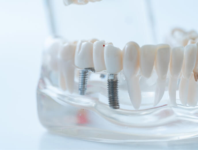 人工歯根を土台にして、失った歯を補うインプラントの構造を説明する模型