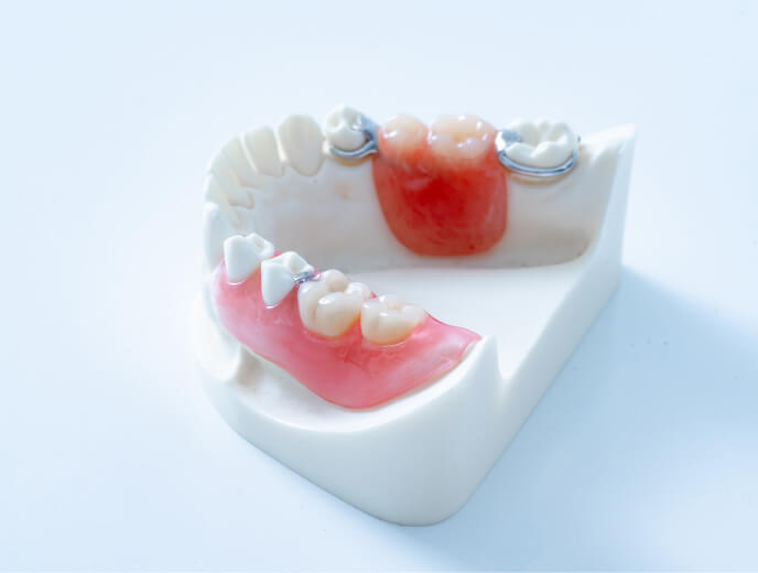 失った歯の部分を、取り外し式の義歯で補う入れ歯治療の模型