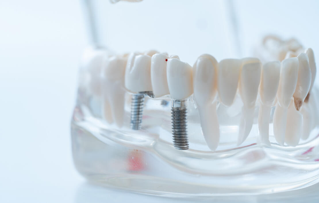 顎の骨にしっかりと固定される、インプラントの構造を分かりやすく示した模型