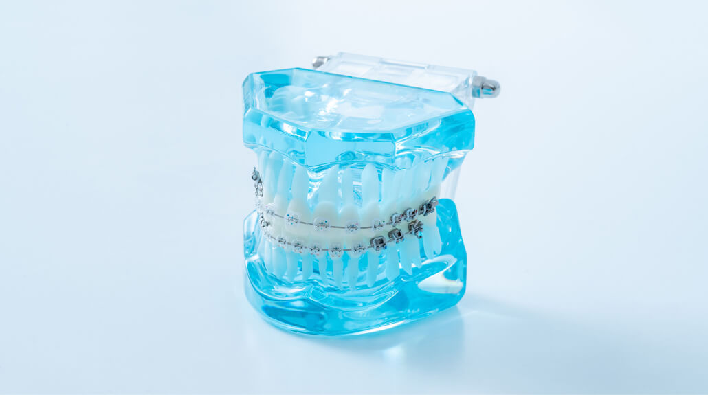 幅広い症例に対応できる、白いブラケットを用いた表側矯正の模型