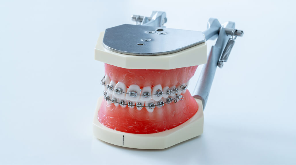 歯の表側に金属の装置を装着する、最もスタンダードな表側矯正治療の模型