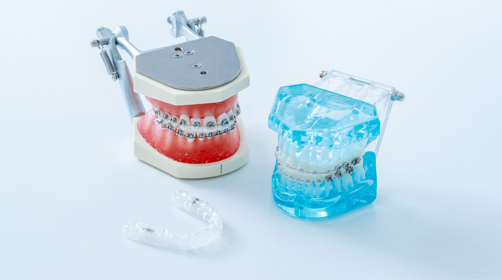 歯の状態や希望に応じて最適な方法を選べる、部分矯正治療の各種装置